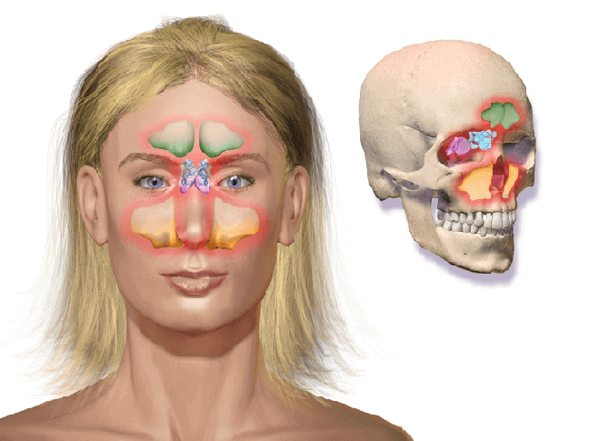 Could This Be the Answer to Your Sinus Problems? 