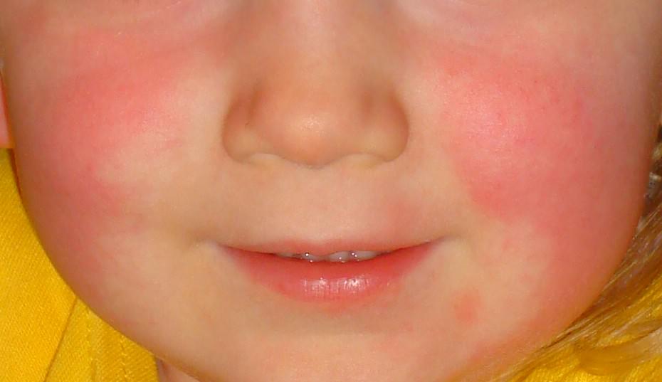 toddler sinus infection