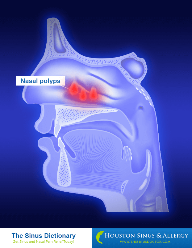 Nasal Polyps - Know Your Nose
