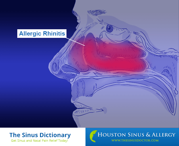 Allergic Rhinitis - Know Your Nose