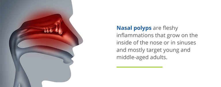 Symptoms Causes And Treatment For Nasal Polyps In Houston