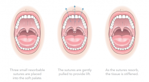 elevoplasty procedure explanation